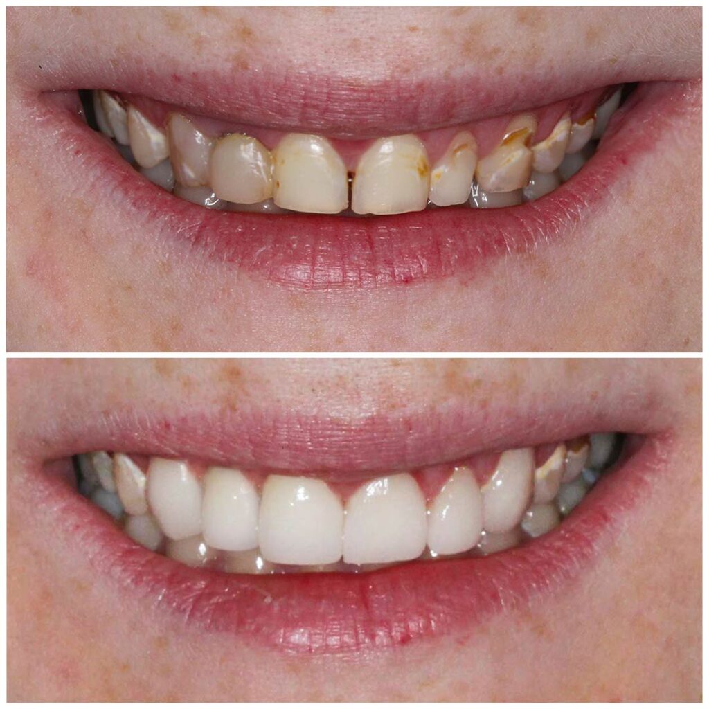smiling-dental-porcelain-veneers-before-after-8